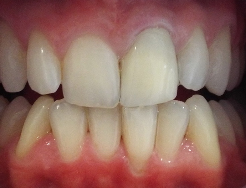 crown and whitening 