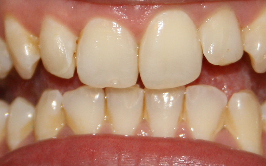six month smiles tooth straightening cork